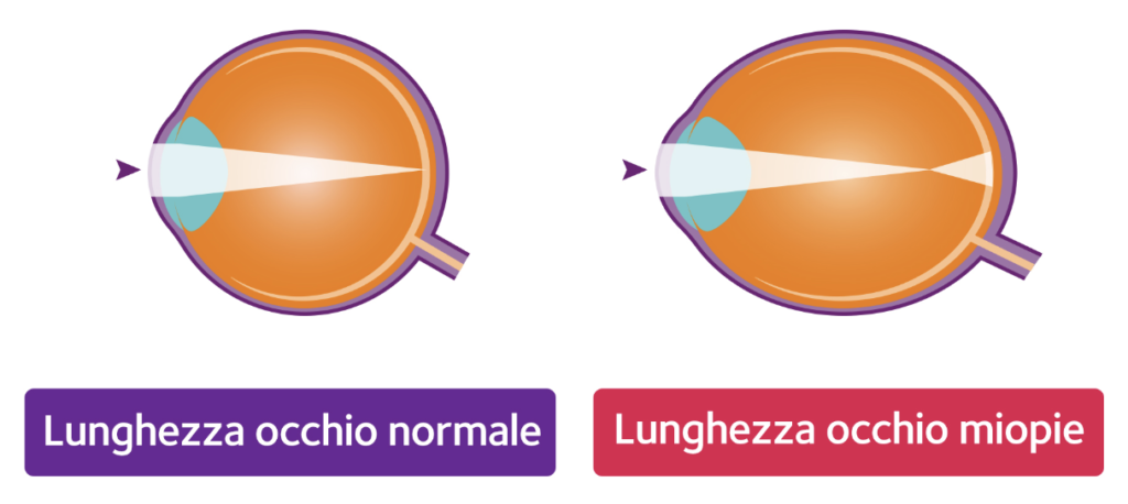Occhio normale - occhio miope