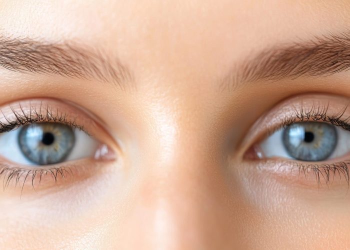 Anisometropia is a condition where the refractive power of the eyes differs significantly, resulting in unequal focus between the eyes